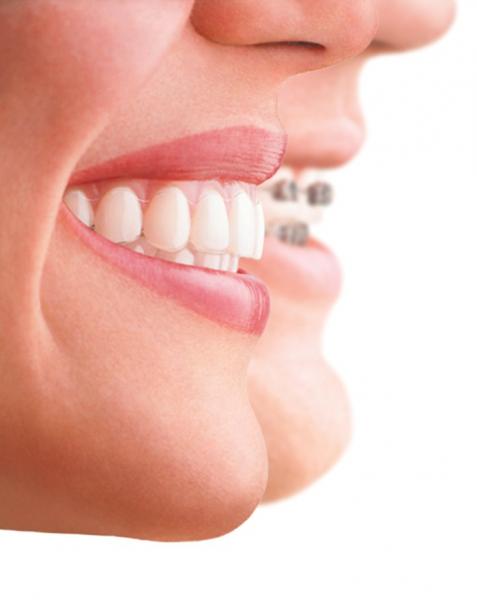 Comparatif aligneur  invisalign et bagues