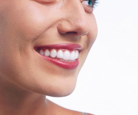 vue de l'aligneur INVISALIGN lors du sourire