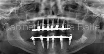 All on six bi maxillaire - radiographie d'un traitement par protocole chirurgical accéléré ou implantation totale et mise en charge immédiate