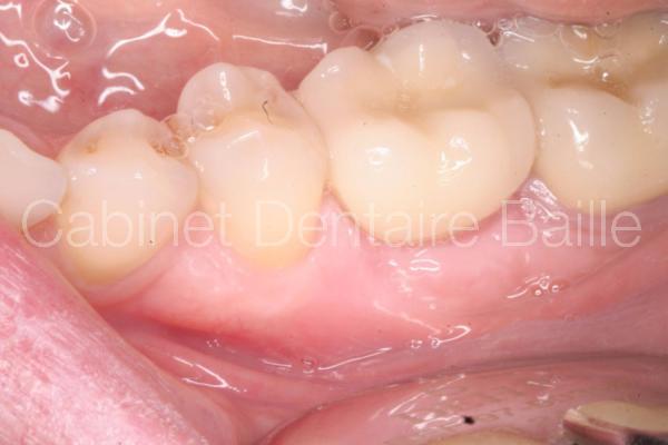 vue intrabuccale de la couronne sur l'implant dentaire