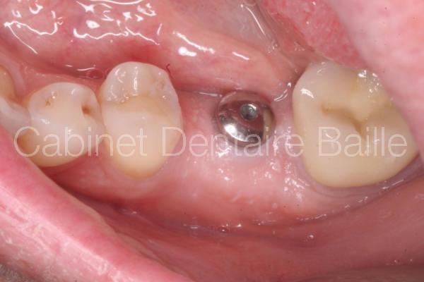 vue intrabuccale de la vis de cicatrisation d'un implant dentaire