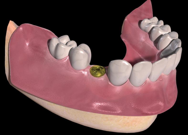 implant en attente d'otéointégration