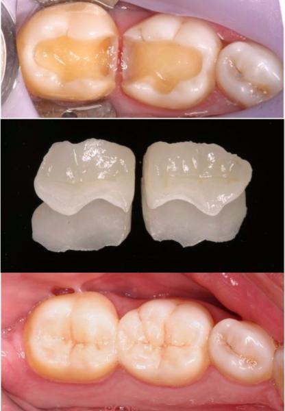 Photos d'un cas clinique de restauration par inlay