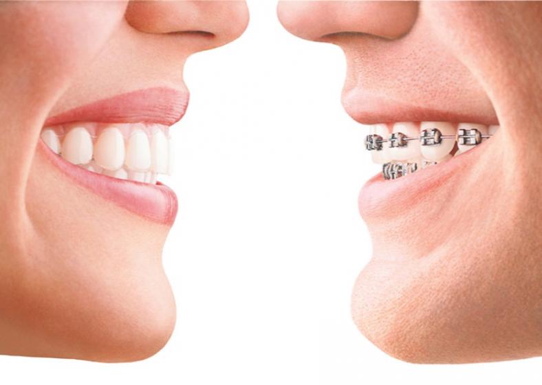 comparatif aligneur INVISALIGN et bagues orthodontiques standards
