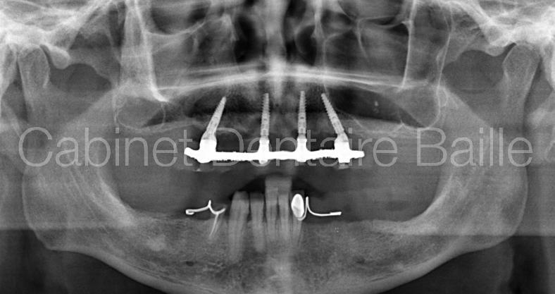 All on four - radiographie d'un traitement par protocole chirurgical accéléré ou implantation totale et mise en charge immédiate