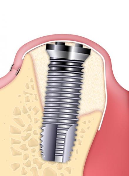 mise en place d'un implant avec greffe osseuse