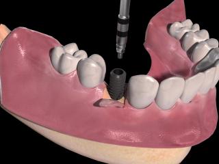 Mise en place de l'implant