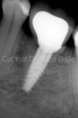 radio aprés traitement avec implant dentaire en place