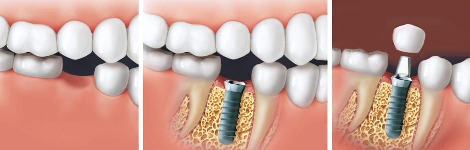 La prothèse dentaire. Qu'est ce que c'est? Types de prothèses dentaires